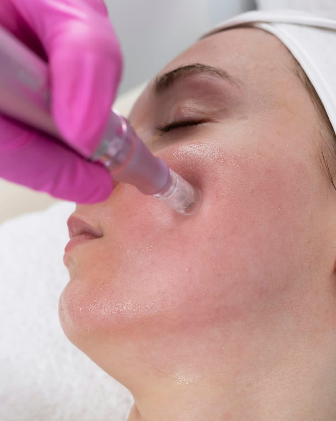 Close-up of a gloved hand holding a microneedling pen against a client’s cheek